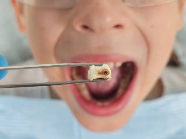 Best Emergency Dental Care for Abscessed Tooth in Derby, CT